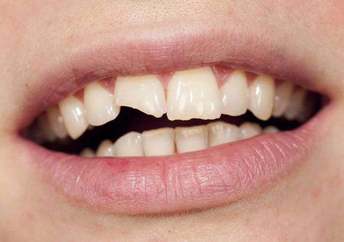 Afgebroken tand glad gemaakt door WellaSmile